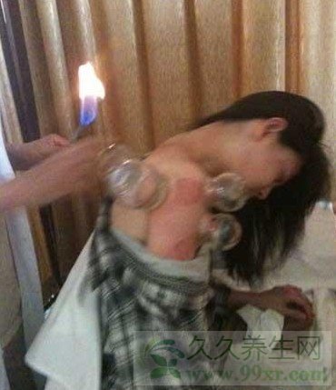 女性拔罐后注意事项