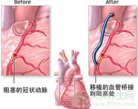 北京卫视养生堂视频20130909:杨跃进讲心梗,心脏支架,心脏搭桥