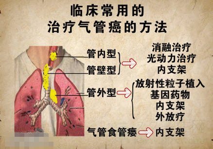北京卫视养生堂视频20141228:王洪武讲中央型气管癌,咳嗽,排痰