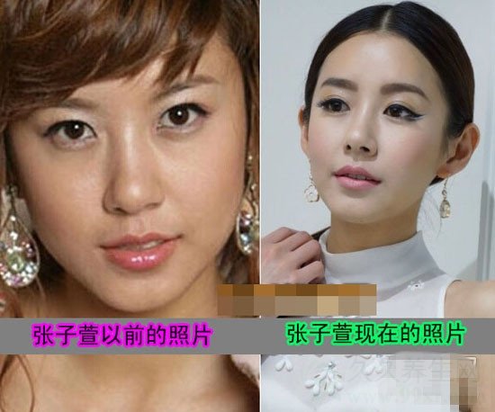 张子萱承认整容
