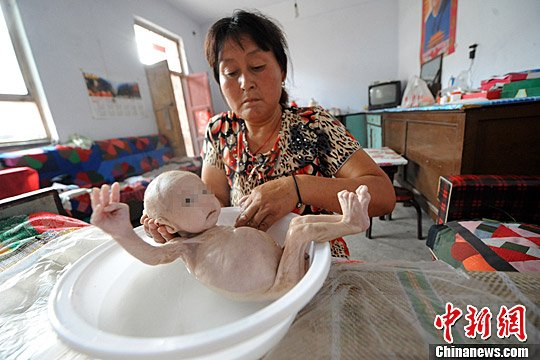 无肛男婴生命垂危
