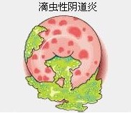 滴虫性阴道炎
