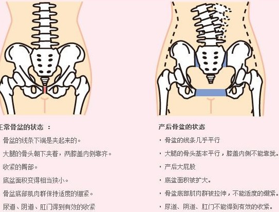 盆骨变形怎么办