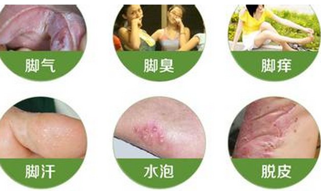 脚癣