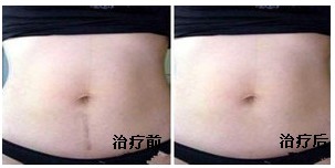 剖腹产后疤痕修复
