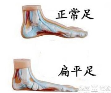 扁平足