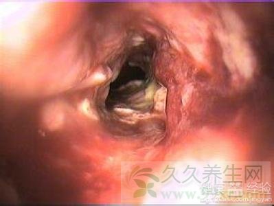食管癌术后体质差发低烧怎么办