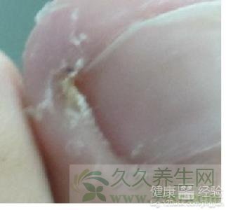 指甲内生怎么办?