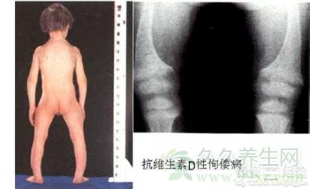 维生素D缺乏是什么?